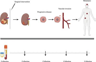 Liquid Biopsies in Renal Cell Carcinoma—Recent Advances and Promising New Technologies for the Early Detection of Metastatic Disease